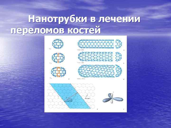 Нанотрубки в лечении переломов костей 