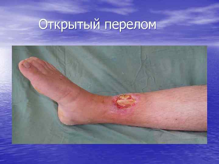 Открытый перелом 