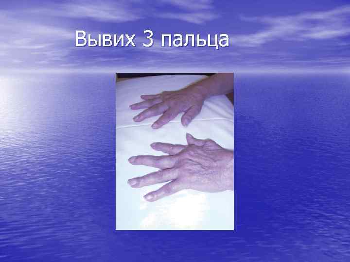 Вывих 3 пальца 