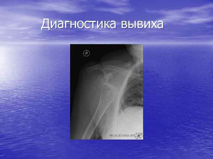 Диагностика вывиха 