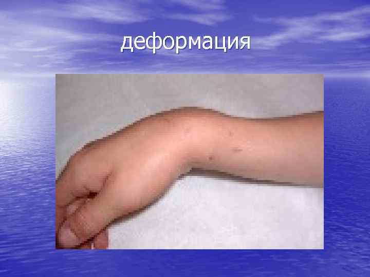 деформация 