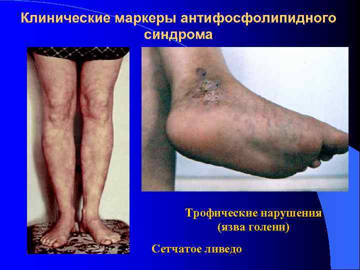 Клинические маркеры антифосфолипидного синдрома Трофические нарушения (язва голени) Сетчатое ливедо 