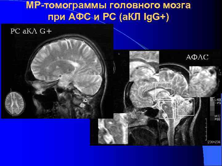 МР-томограммы головного мозга при АФС и РС (а. КЛ Ig. G+) 