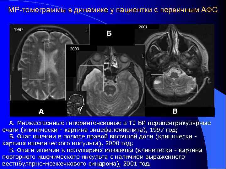 МР-томограммы в динамике у пациентки с первичным АФС Б А В А. Множественные гиперинтенсивные