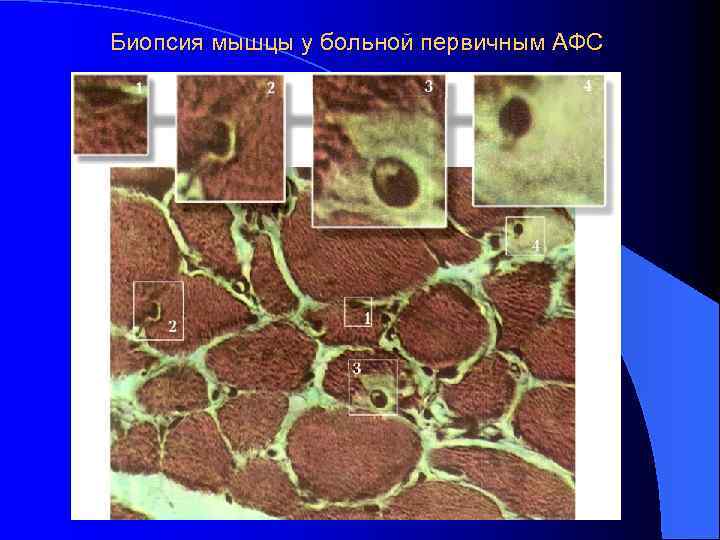 Биопсия мышцы у больной первичным АФС 