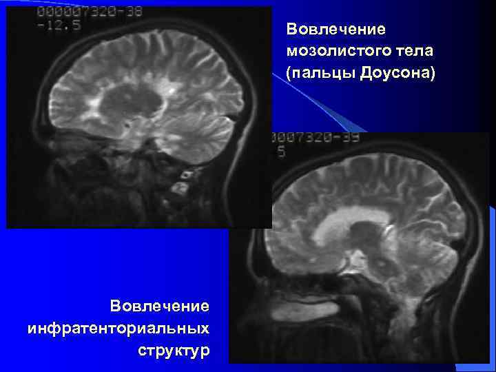 Вовлечение мозолистого тела (пальцы Доусона) Вовлечение инфратенториальных структур 