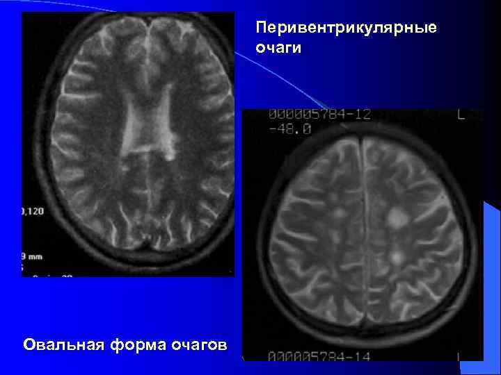 Мр картина перивентрикулярной лейкопатии