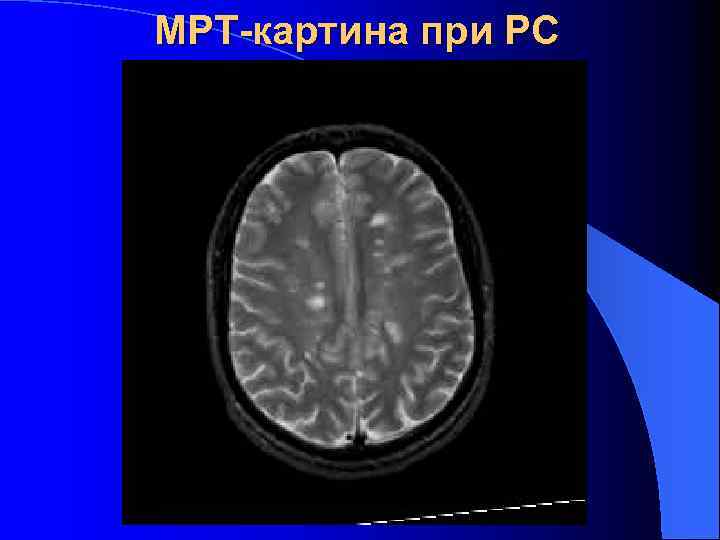 МРТ-картина при РС 
