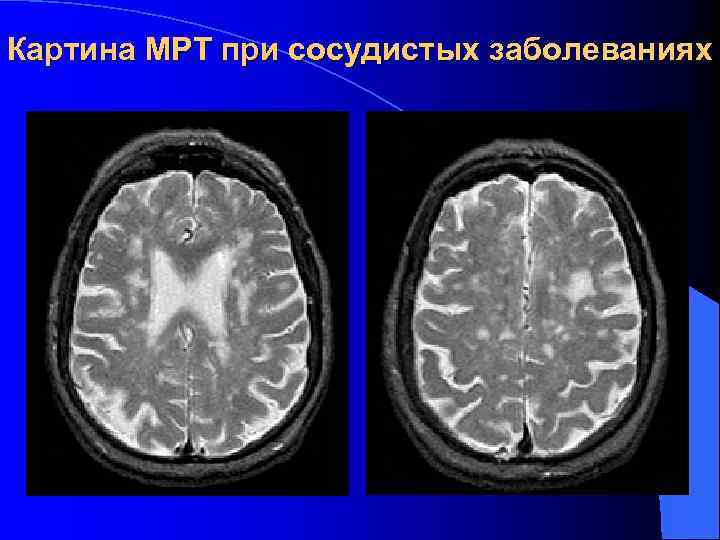 Мрт картина. Мрт при. Мрт картина при РС. Магнитно-резонансный томография картины.