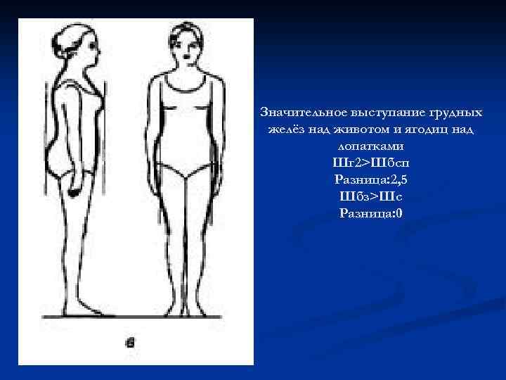 Значительное выступание грудных желёз над животом и ягодиц над лопатками Шг 2>Шбсп Разница: 2,