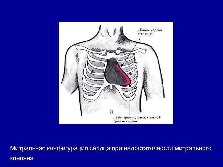 Митральная конфигурация сердца при недостаточности митрального клапана 