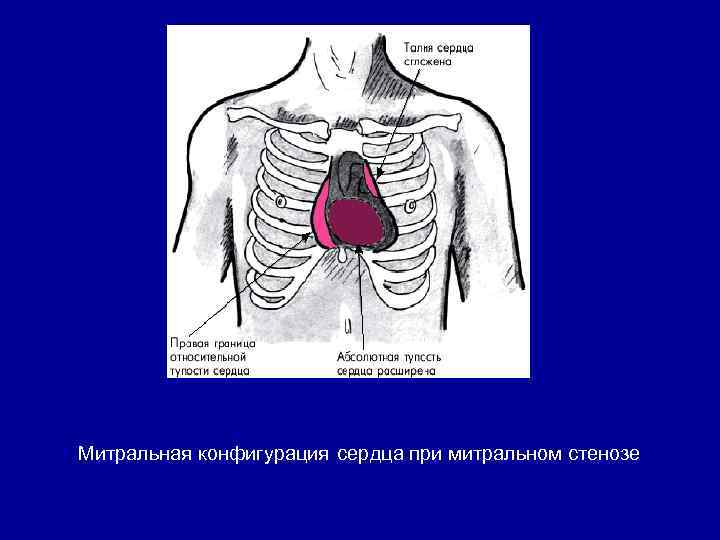 Митральная конфигурация сердца при митральном стенозе 