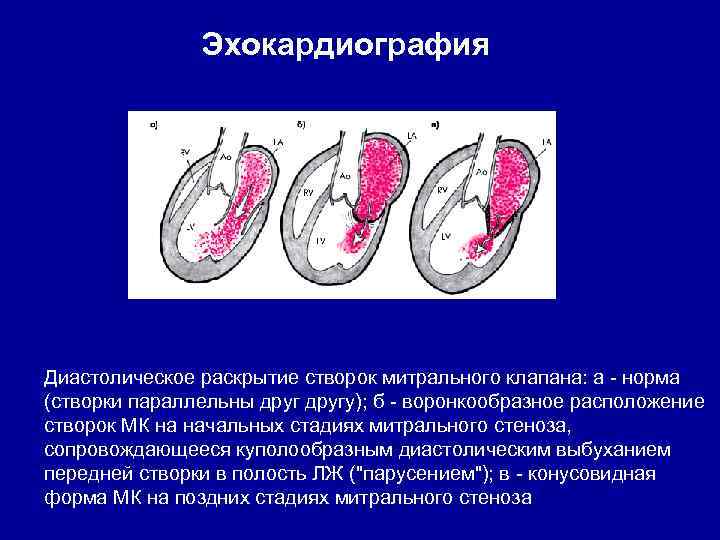 Эхокардиография Диастолическое раскрытие створок митрального клапана: а - норма (створки параллельны другу); б -