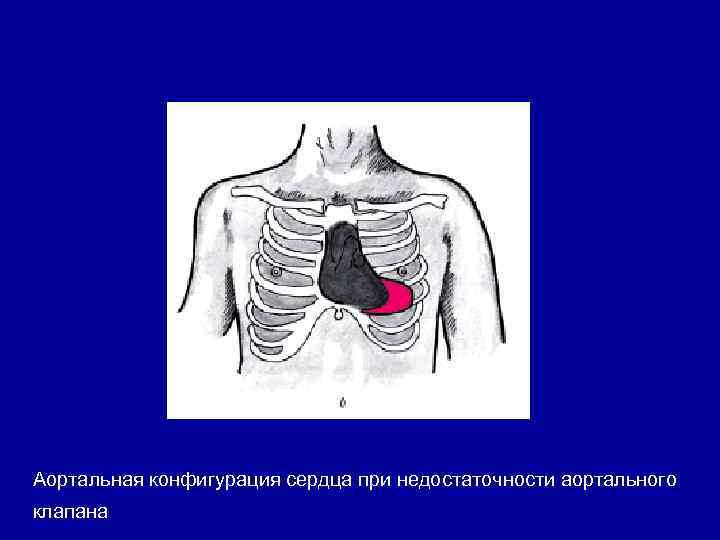 Аортальная конфигурация сердца схема