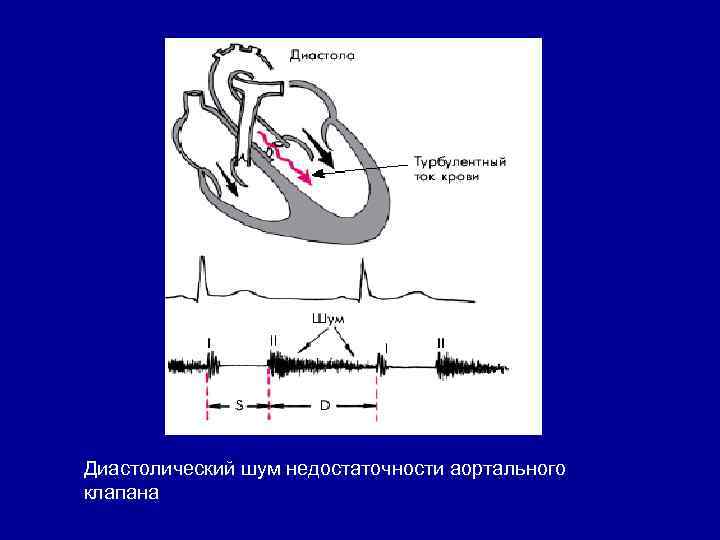 Диастолический шум недостаточности аортального клапана 