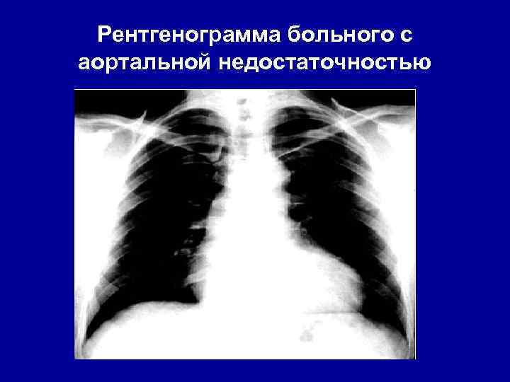 Рентгенограмма больного с аортальной недостаточностью 