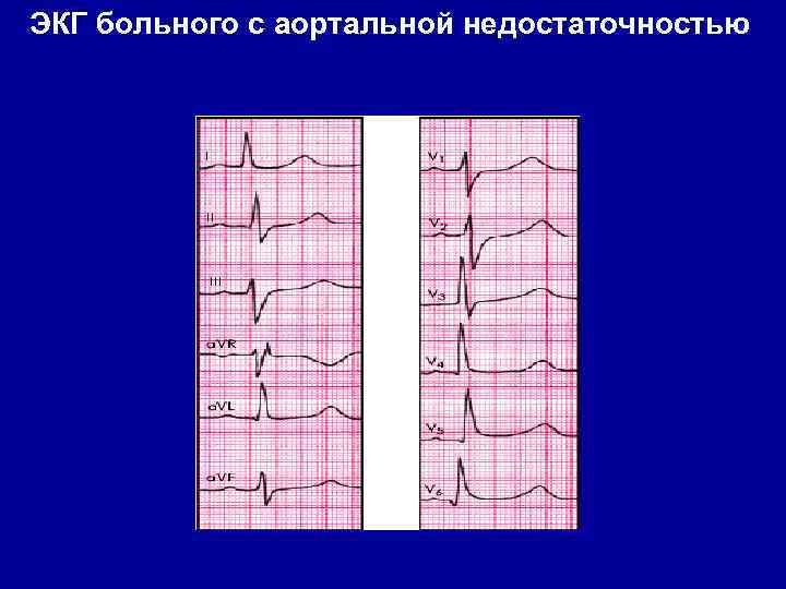ЭКГ больного с аортальной недостаточностью 