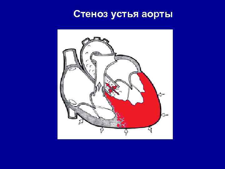 Стеноз устья аорты 