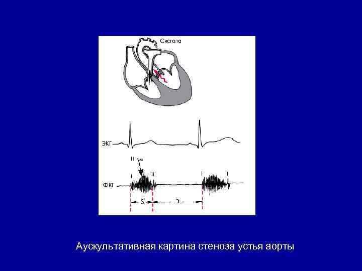 Аускультативная картина i тона сердца при стенозе устья аорты