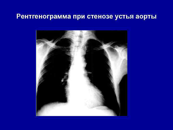 Рентгенограмма при стенозе устья аорты 