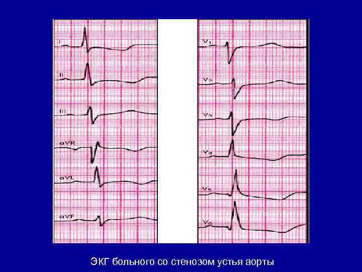ЭКГ больного со стенозом устья аорты 