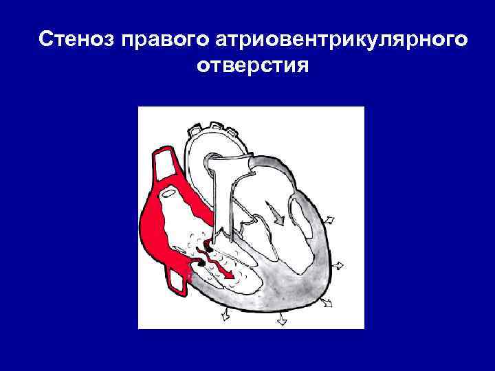 Стеноз правого атриовентрикулярного отверстия 