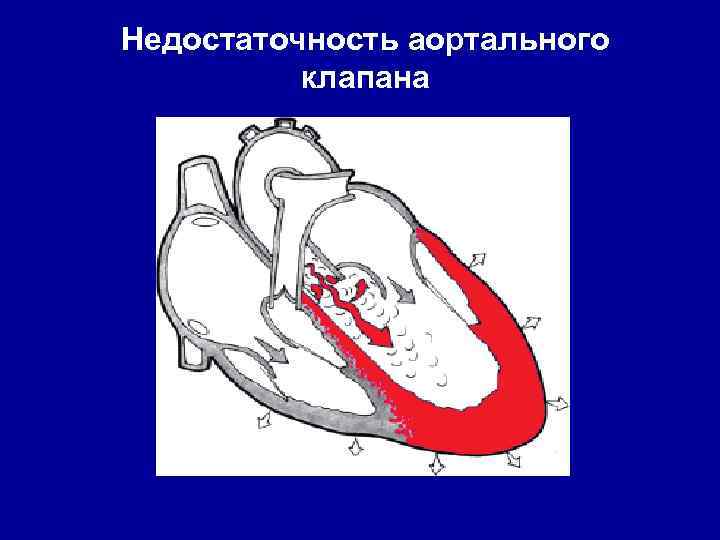 Недостаточность аортального клапана 