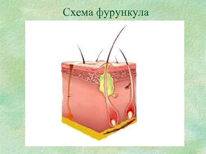 Схема фурункула 