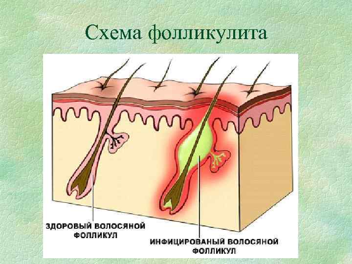 Схема фолликулита 