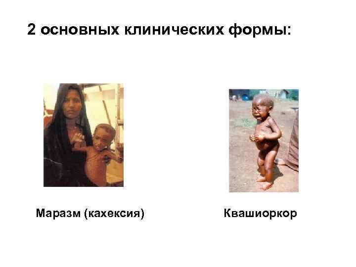 2 основных клинических формы: Маразм (кахексия) Квашиоркор 