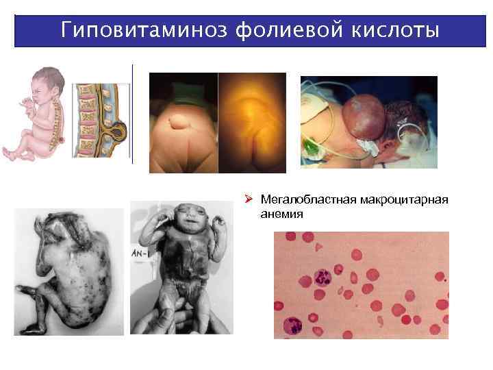 Гиповитаминоз фолиевой кислоты Мегалобластная макроцитарная анемия 