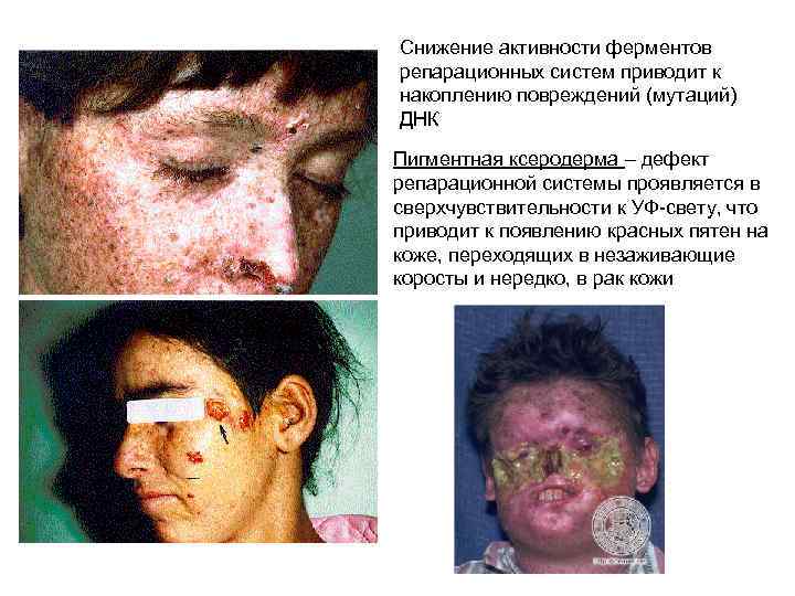 Снижение активности ферментов репарационных систем приводит к накоплению повреждений (мутаций) ДНК Пигментная ксеродерма –