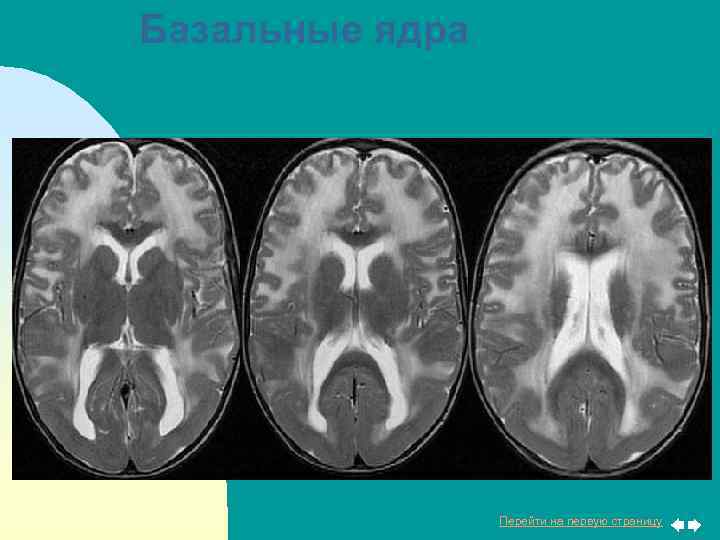 Базальные ядра Перейти на первую страницу 