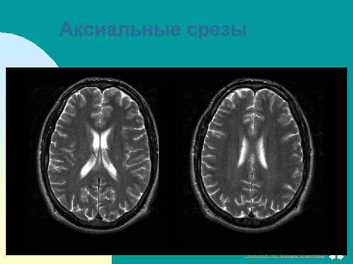 Аксиальные срезы Перейти на первую страницу 