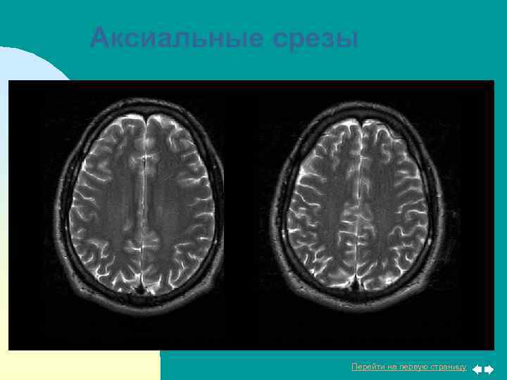 Аксиальные срезы Перейти на первую страницу 