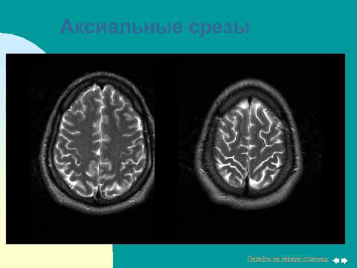 Аксиальные срезы Перейти на первую страницу 