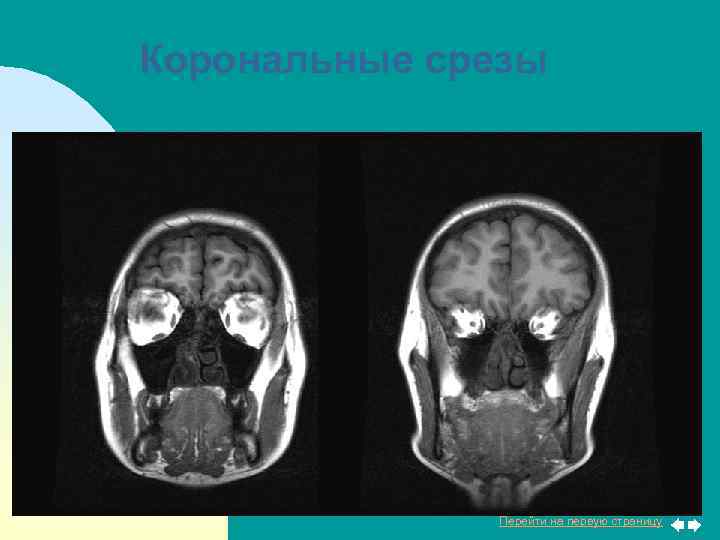 Корональные срезы Перейти на первую страницу 