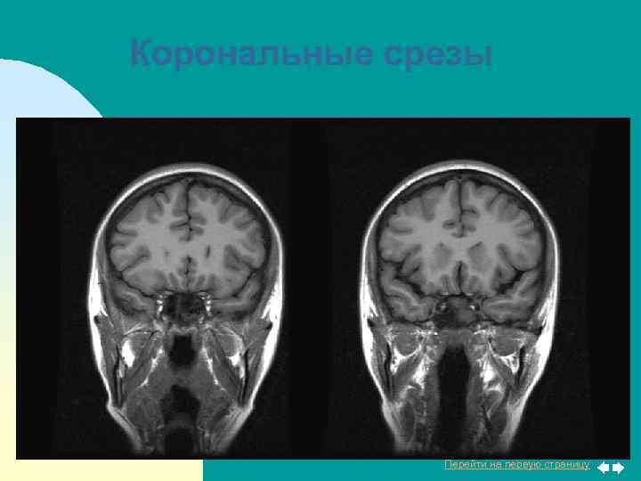 Корональные срезы Перейти на первую страницу 