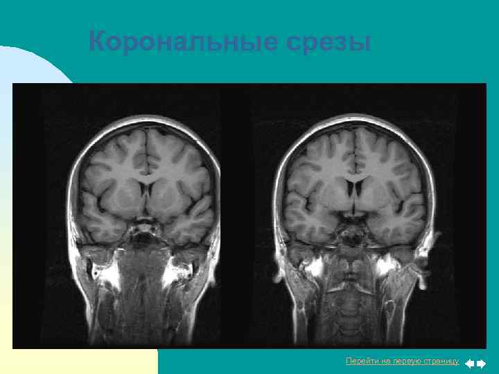 Корональные срезы Перейти на первую страницу 