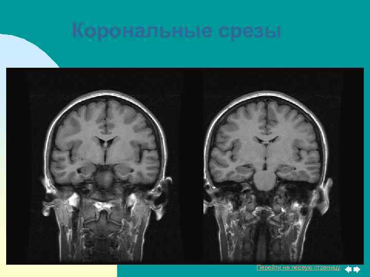 Корональные срезы Перейти на первую страницу 