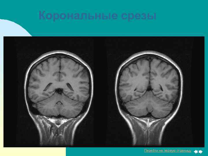 Корональные срезы Перейти на первую страницу 