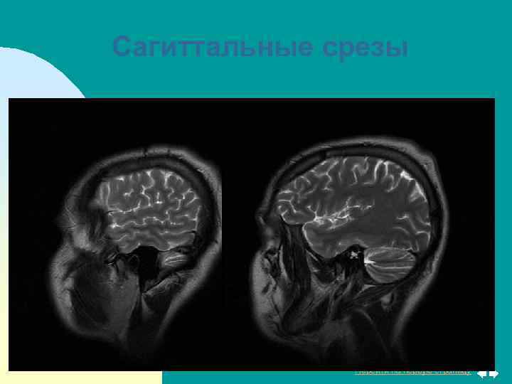 Сагиттальные срезы Перейти на первую страницу 