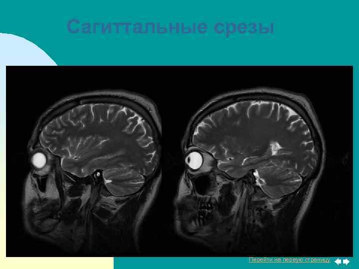 Сагиттальные срезы Перейти на первую страницу 