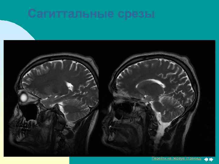 Сагиттальные срезы Перейти на первую страницу 