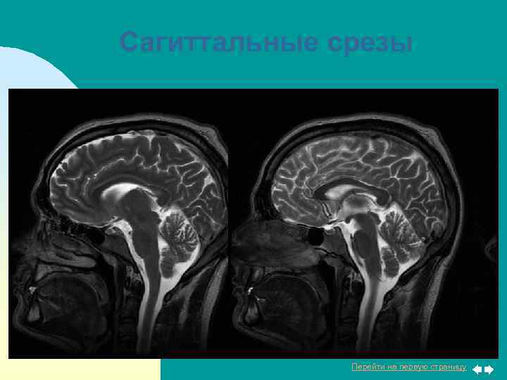 Сагиттальные срезы Перейти на первую страницу 