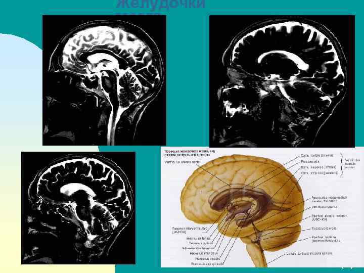 Желудочки мозга Перейти на первую страницу 