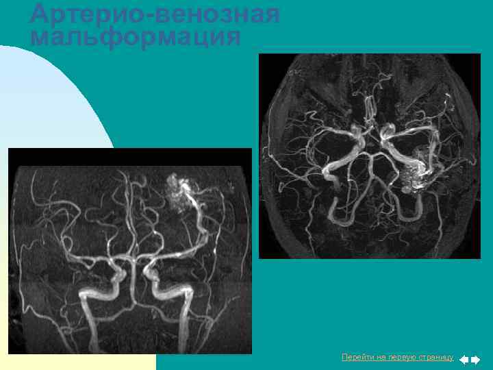 Артерио-венозная мальформация Перейти на первую страницу 