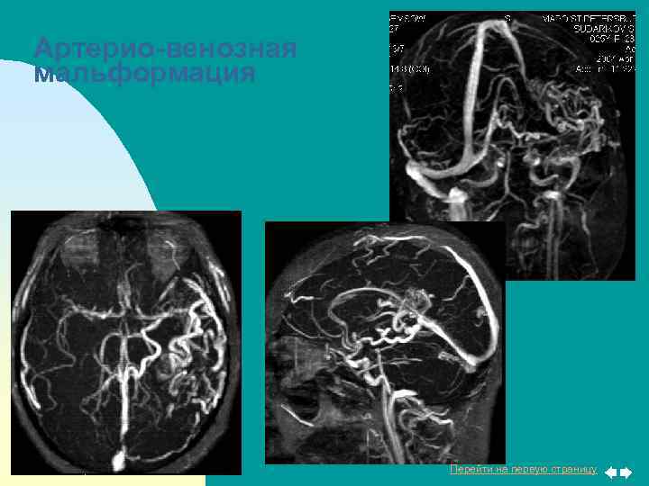 Артерио-венозная мальформация Перейти на первую страницу 