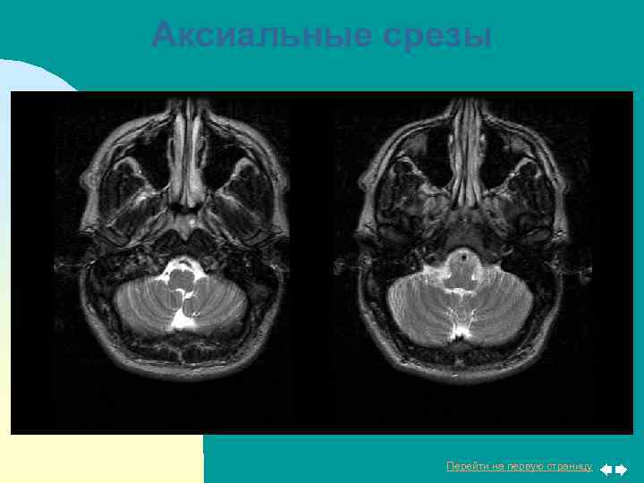 Аксиальные срезы Перейти на первую страницу 