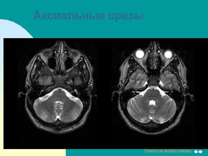 Аксиальные срезы Перейти на первую страницу 